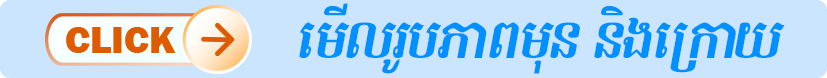ពង្រីកដើមទ្រូងដោយអង់ដូស្កូប