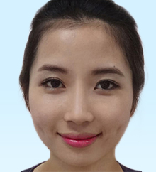 Bấm má lúm đồng tiền