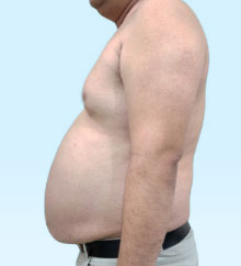 Căng da bụng - Thu da bụng