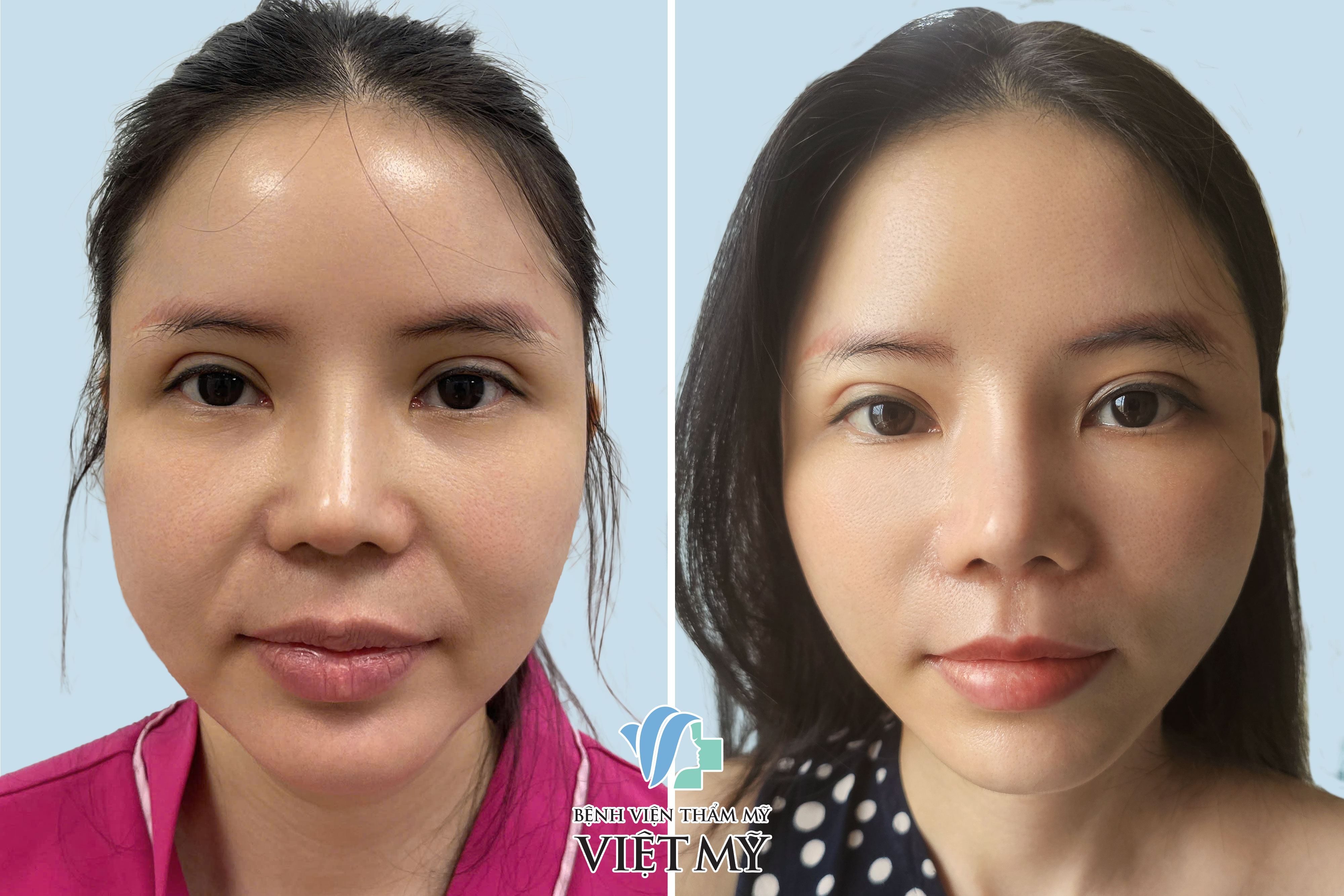 Thẩm mỹ nhân trung