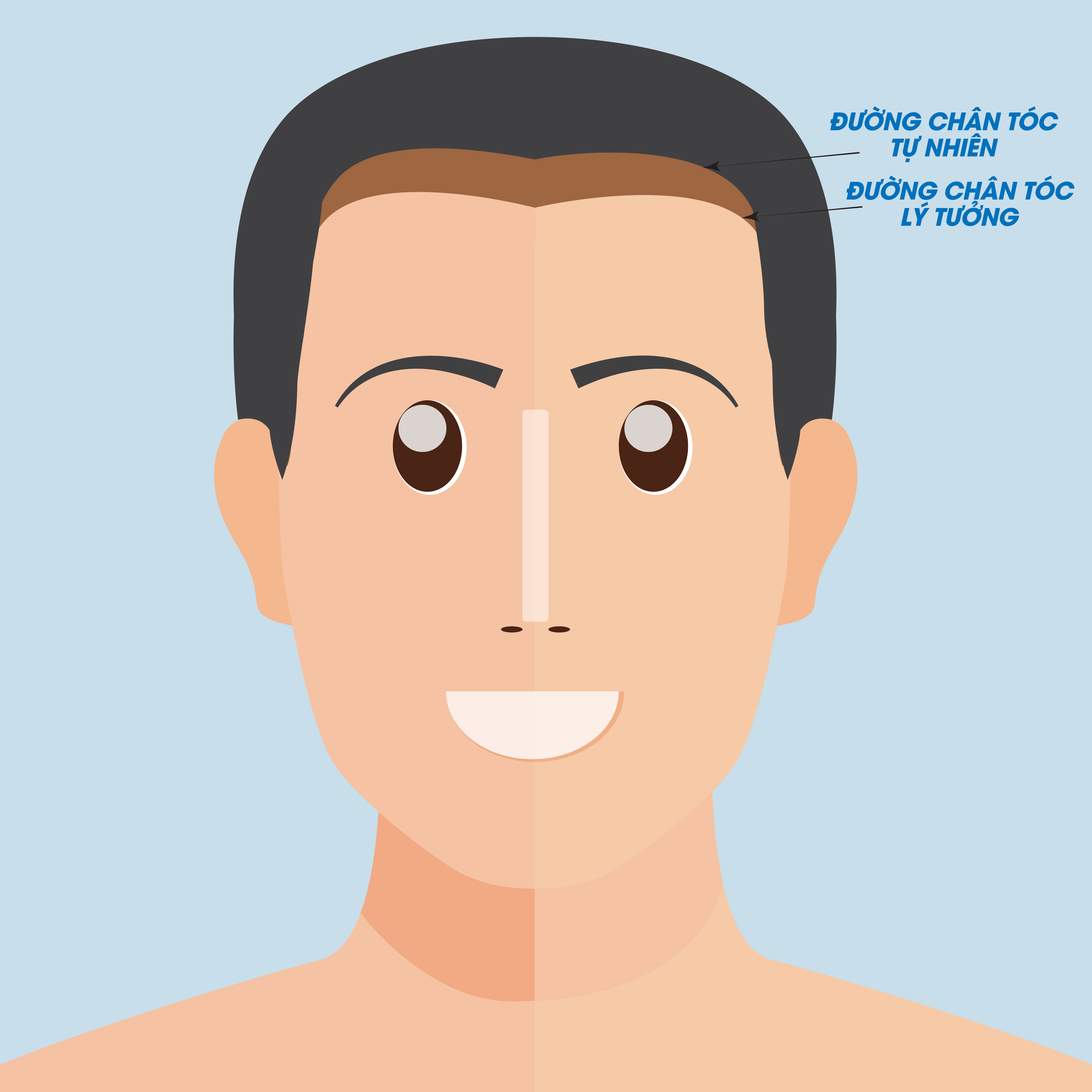 Phẫu thuật hạ đường chân tóc