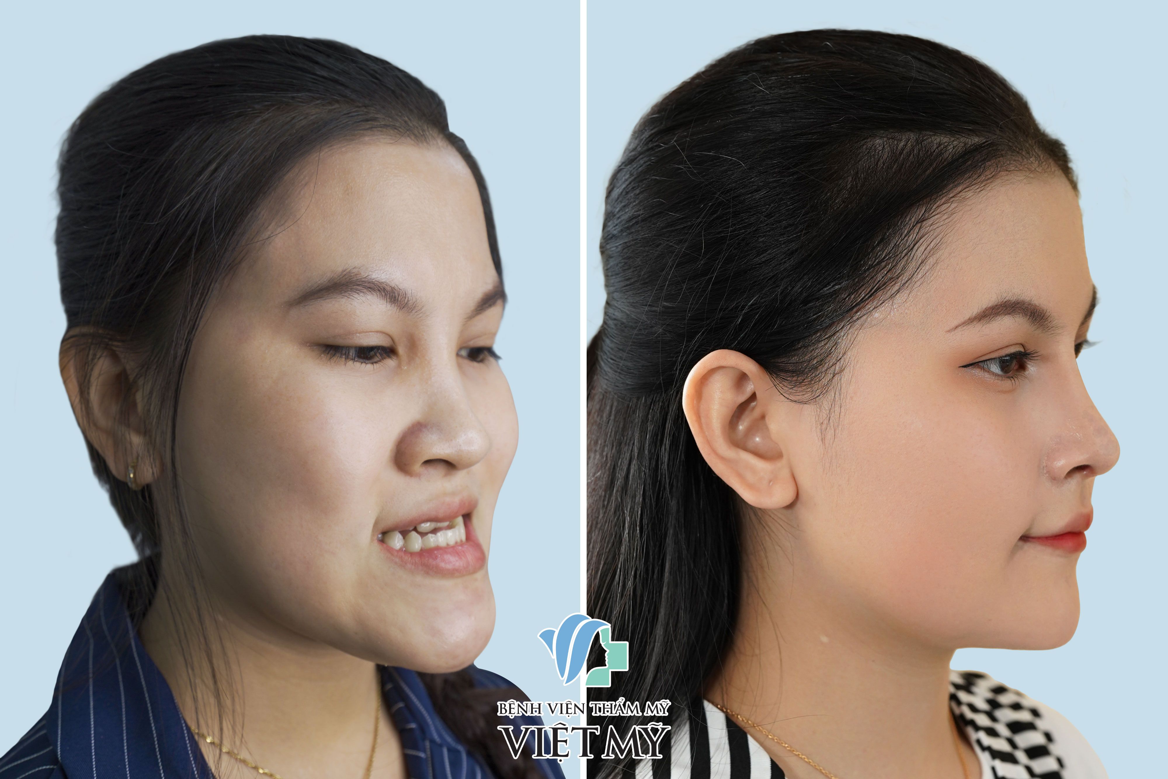 Phẫu thuật điều trị hàm móm