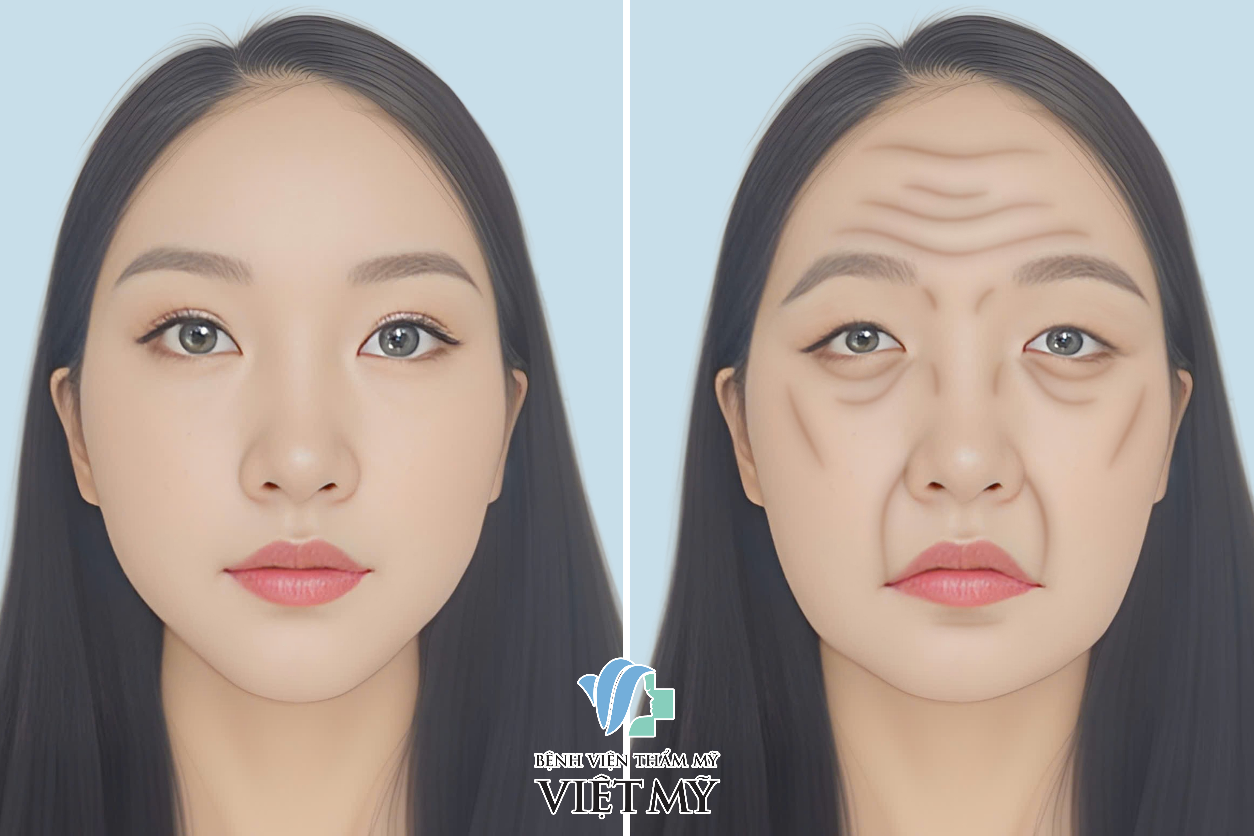 Cấy mỡ trẻ hóa vùng mặt