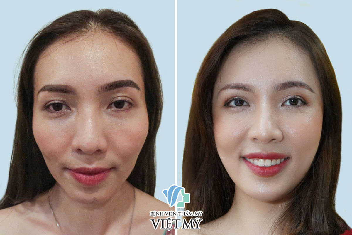 Cấy mỡ tự thân các vùng