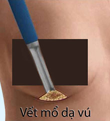 Nâng ngực mổ hở nếp dạ vú
