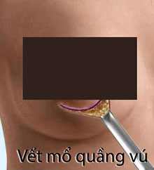 Nâng ngực mổ hở quầng vú