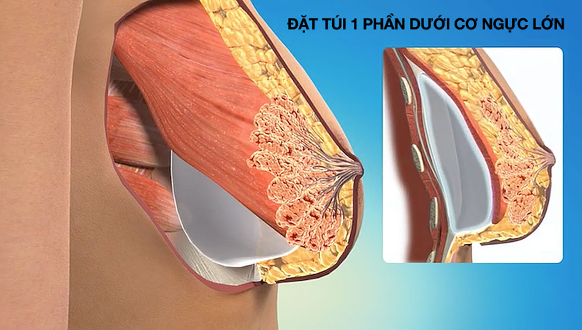 Nâng ngực phương pháp Dual Plane