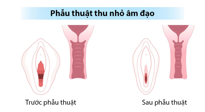 Phẫu thuật trẻ hóa, thu hẹp âm đạo