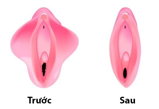 Phẫu thuật thu nhỏ môi âm đạo