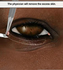 Cắt mí dưới - Bác sĩ Chiêm Quốc Thái