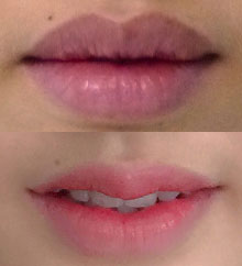 Cắt môi dày thành môi mỏng