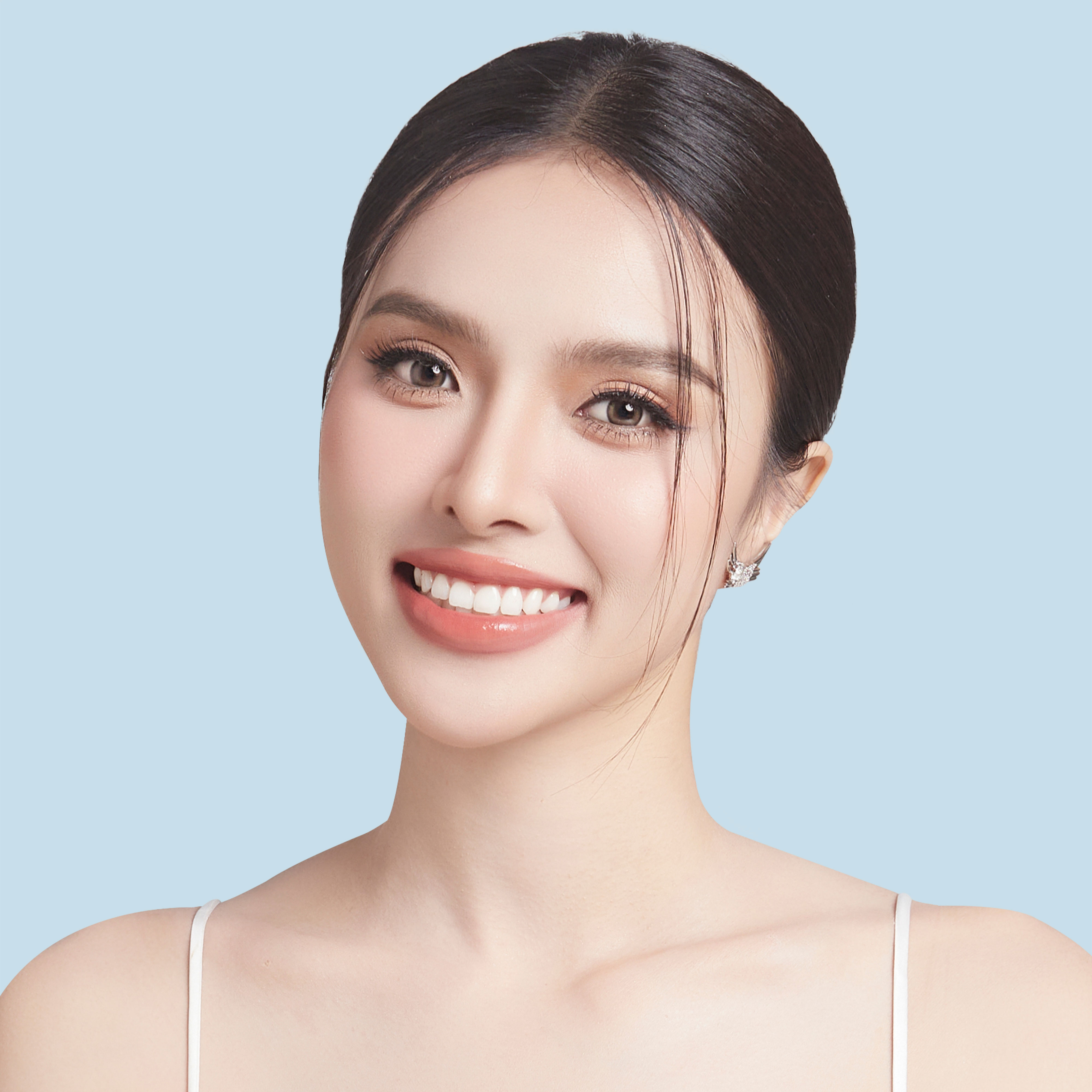 Phương pháp nâng môi hở lợi