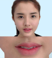 Tạo hình môi trái tim, môi cười, môi hạt lựu